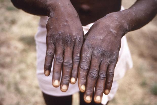 Monkeypox is spreading in the community, doctors have warned (CDC/AP)